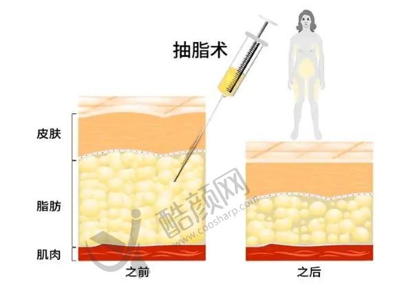 孙泽芳是北京纯脂的吸脂填充口碑医生，可以在线预约孙泽芳医生