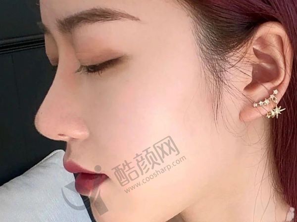 佛山美莱膨体隆鼻价格7900元起，术后鼻型更立体更自然