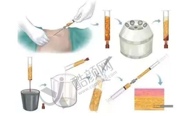  青岛大学附属医院大腿吸脂多少钱？术后恢复效果 & 价格参考