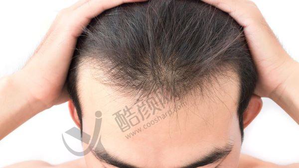 南方医 科 大学南方医院的植发技术介绍