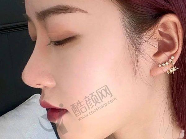 佛山美莱膨体隆鼻价格7900元起