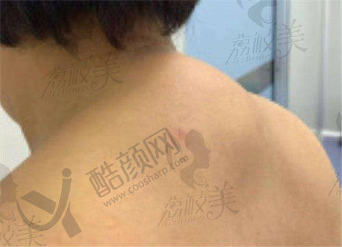 乌鲁木齐富贵包治疗医院推荐