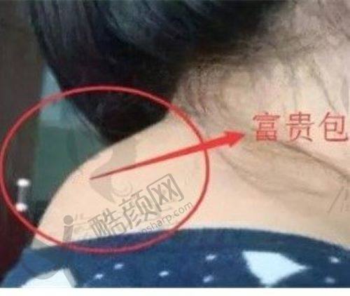 乌鲁木齐去除富贵包哪家医院好