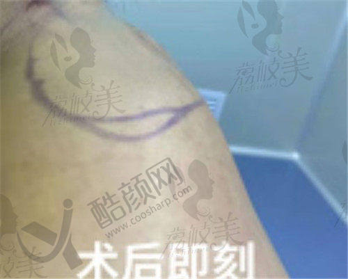 乌鲁木齐华美整形医院去除富贵包怎么样