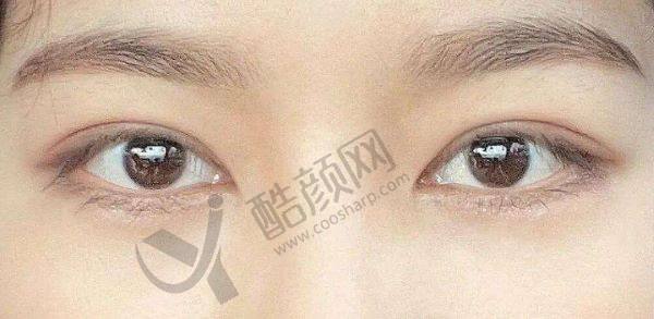 丰联丽格师丽丽医生做眼修复怎么样