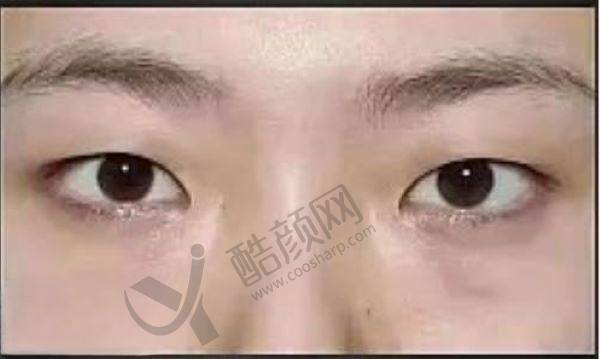 杜园园修复外眼角技术好吗