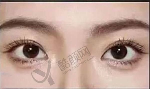 杜园园做眼修复怎么样