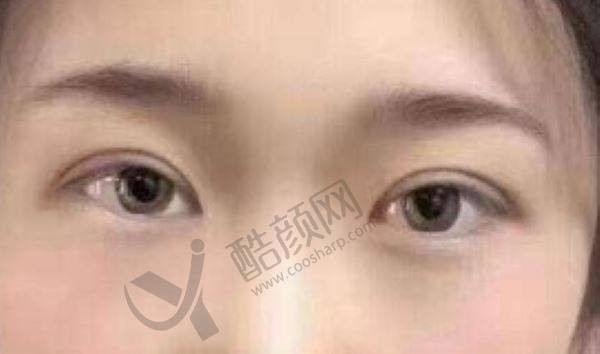 杜园园修复眼角怎么样