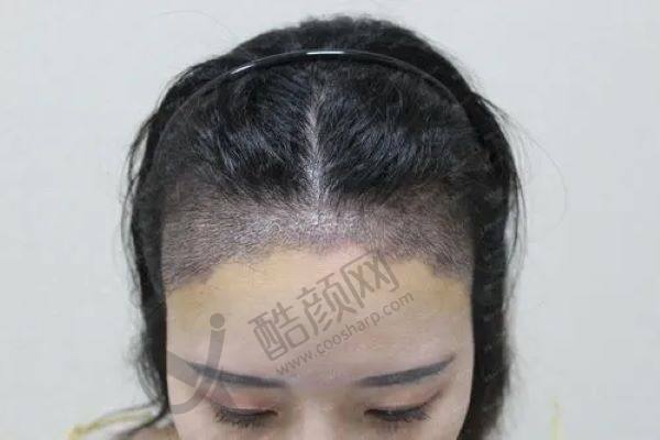 北京碧莲盛脱发植发价目表