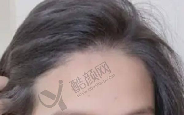 北京碧莲盛医院术后养发价格