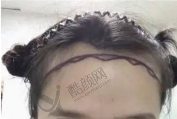 北京碧莲盛医院植发到底怎么样