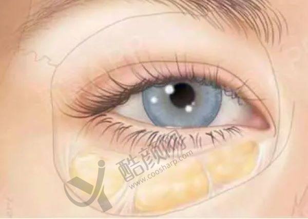 健丽去眼袋手术能维持几年