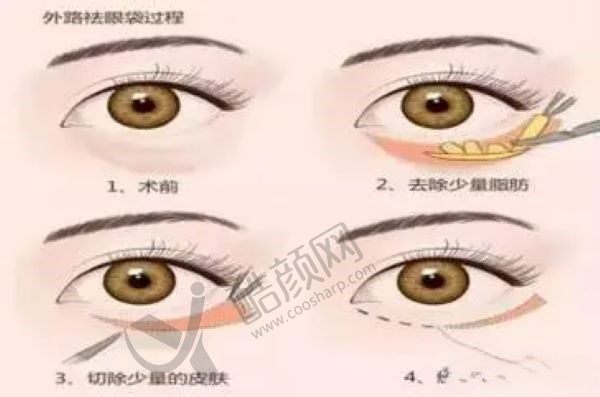 健丽去眼袋维持年限与反弹概率