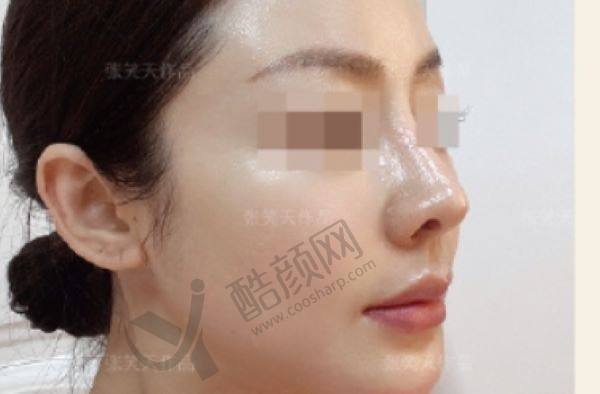 广州广大整形医院磨骨手术的价格