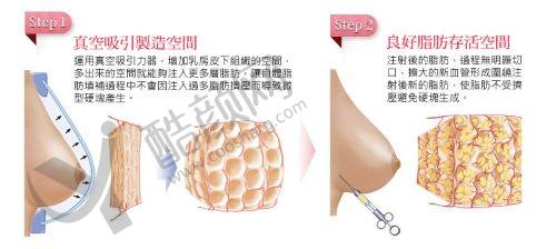 成都八大处医疗美容医院整形外科做缩胸手术怎么样