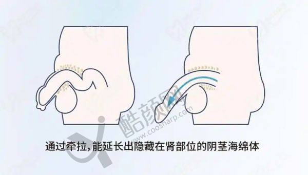 贵阳男性延长手术哪个医院好