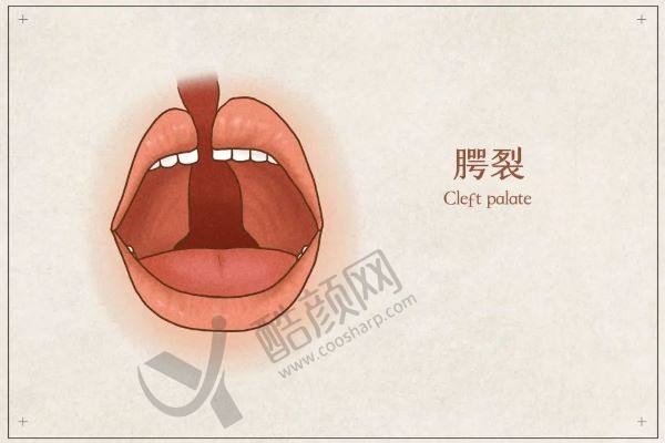 广州哪个医生做唇腭裂手术高