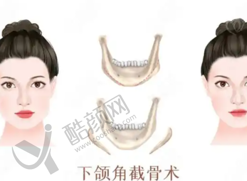 兰州时光激光整形医院祛眼袋真实评价