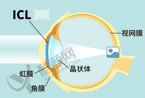 武汉佰视佳眼科周跃明医生做半飞秒手术价格11500元起，连锁名院个性化定制超靠谱 