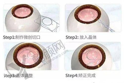 六、广州佰视佳眼科医院价格表：（仅供参考）