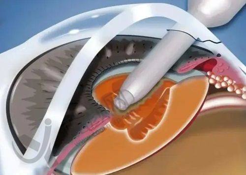 七、广州佰视佳眼科医院真实的患者评价如下：
