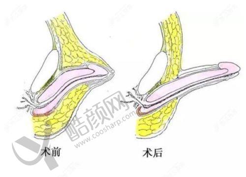 成都八大处陶俊医生做鼻子怎么样？
