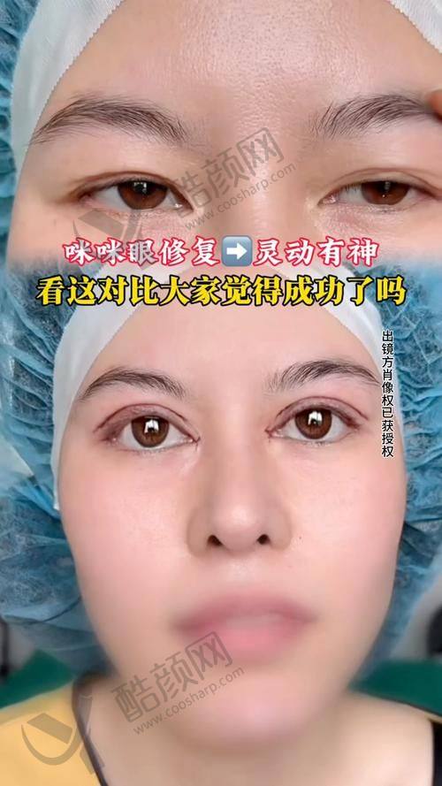 大连爱德丽格刘志刚做眼修复价格5万元起，金刀奖医生+高端技术重塑明眸 