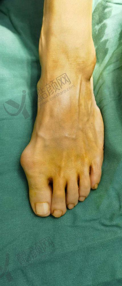 七、重庆骑士医院大脚骨科真实的患者评价如下：