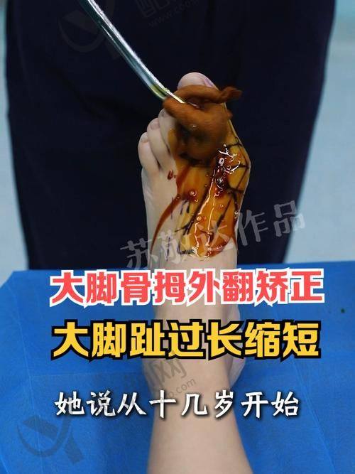 六、重庆骑士医院大脚骨科价格表：（仅供参考）