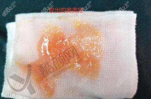 广州荔医齐云香医生做胸部异物取出价格16000元起，多维技术精细操作，口碑超棒！ 
