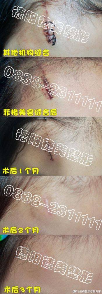 六、重庆骑士医院疤痕科真实的患者评价如下：