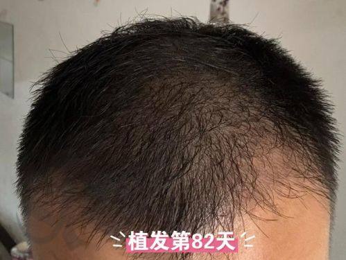六、重庆骑士医院植发科价格表：（仅供参考）