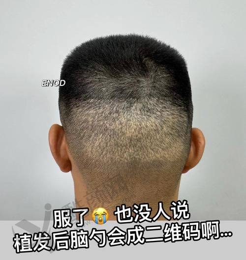 七、重庆骑士医院植发科真实的患者评价如下：