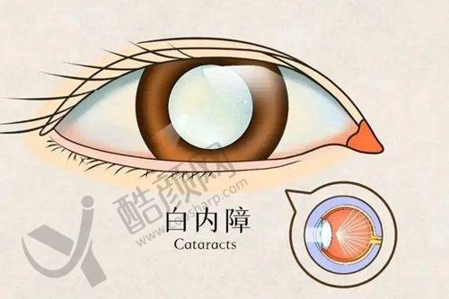 大连爱尔眼科医院白内障三焦点晶体手术的具体优势