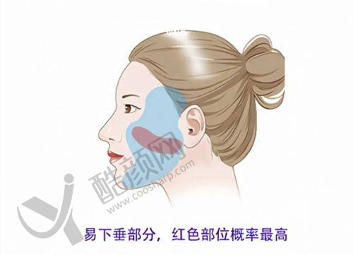 深圳健丽：个性化方案设计，不开刀去眼袋