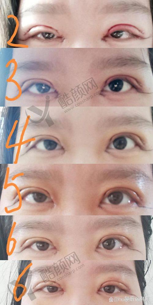重庆当代整形外科医院谢锦清做全切双眼皮价格5500元起，3级资质医院性价比超高！ 