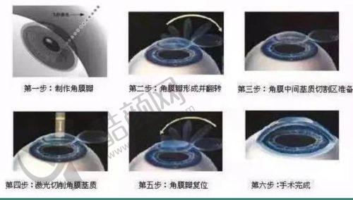 深圳佰视佳眼科林可劼医生做半飞秒近视手术价格9800元起，连锁名院技术优 
