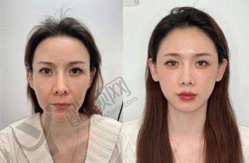成都素美医疗美容无痕筋膜手术真实评价