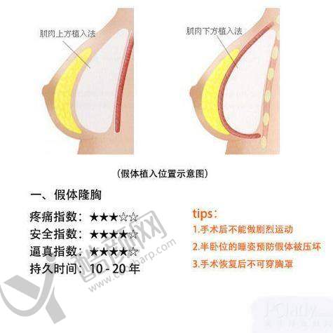 南京美莱夏建军医生丰胸怎么样？