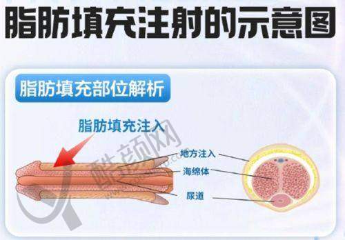 刘远程和李建刚术后 5 年数据对比