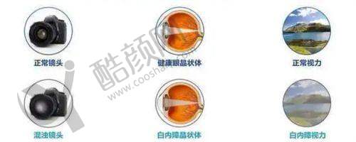 成都普瑞眼科医院艾碧君医生介绍