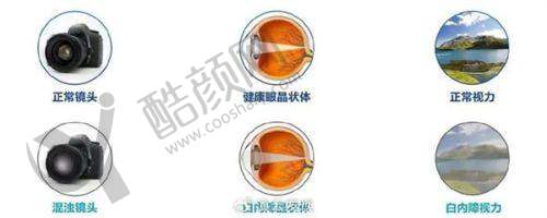 成都普瑞眼科医院艾碧君医生做普通白内障手术价格2800元起，三级医院就诊超舒适 