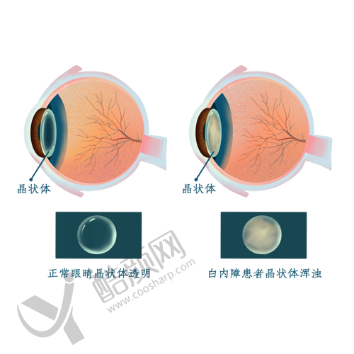 成都普瑞眼科医院普通白内障手术的真实评价