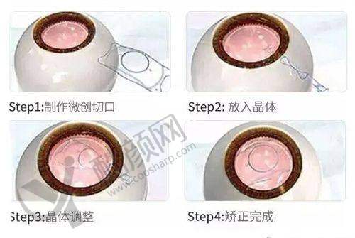 西安四院眼科省钱攻略