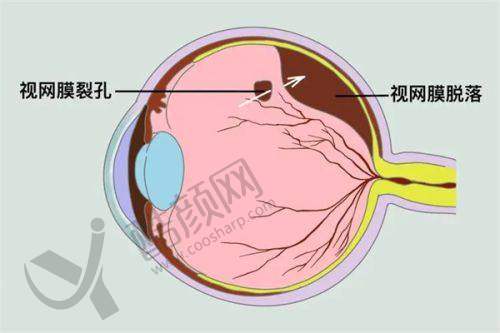 北京华德眼科医院段安丽后巩膜加固术价格