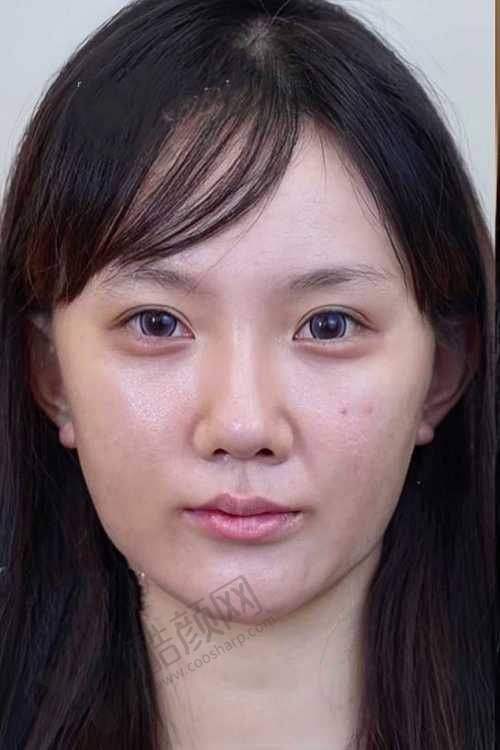 北京丽合热玛吉项目真实评价