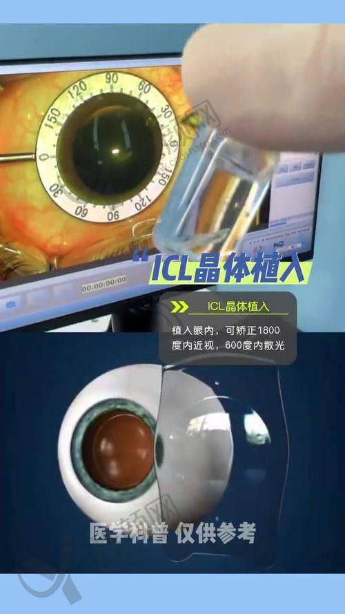 嘉兴爱尔眼科ICL晶体植入相关医生介绍