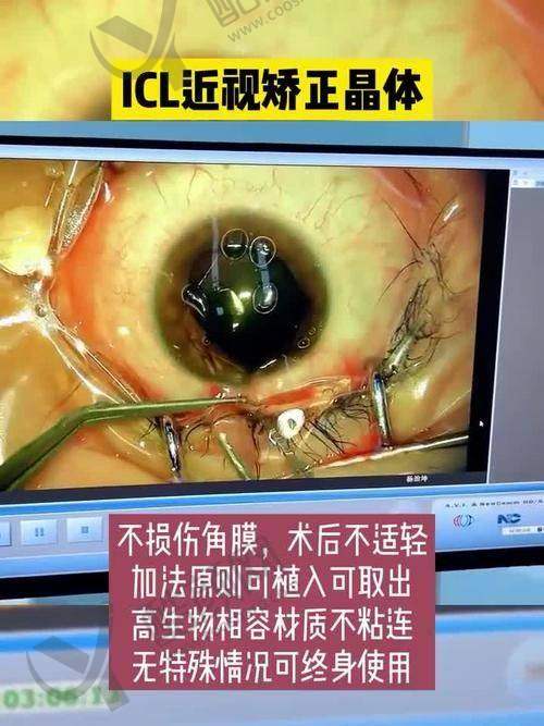 嘉兴爱尔眼科ICL晶体植入项目优势