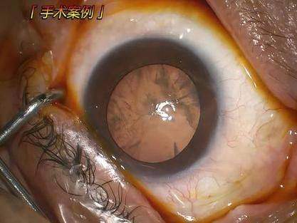 上海和平眼科医院三焦点人工晶体植入术的真实评价