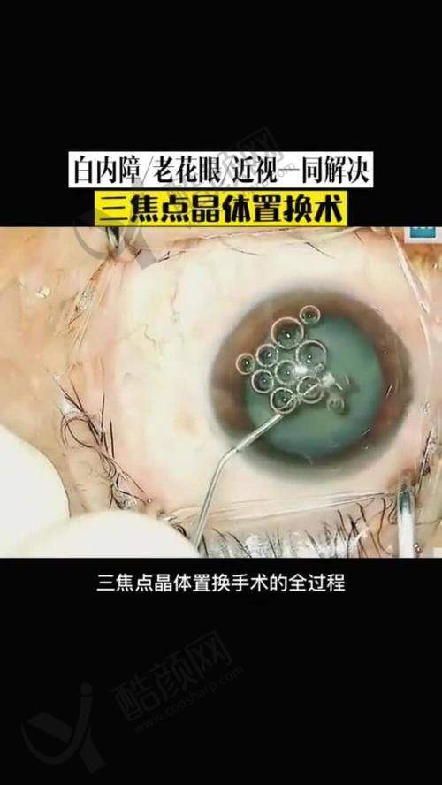 上海和平眼科医院开展三焦点人工晶体植入术，价格 35000 元，技术成熟服务贴心超靠谱 